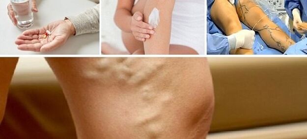 Tratamentul varicelor